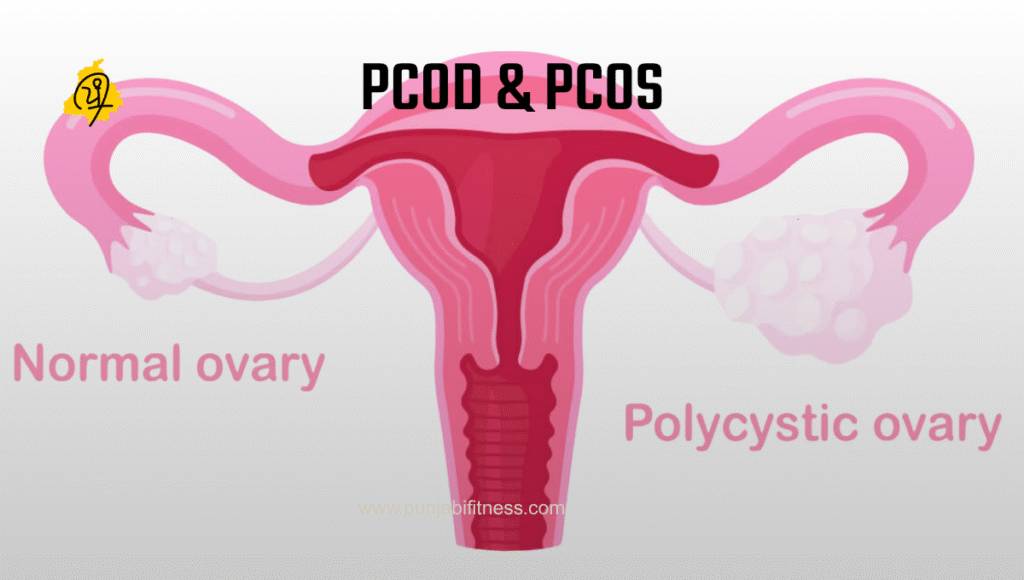 What is PCOD? Everything Every Young Woman Should Know